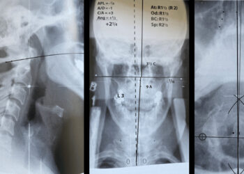 Atlas Subluxation Complex and Dizziness