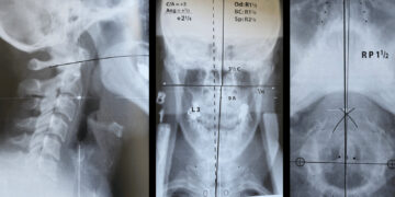 Atlas Subluxation Complex and Dizziness