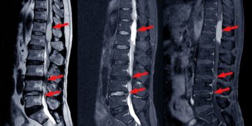 What Is Spinal Stenosis? | Symptoms, Causes, Treatment Methods