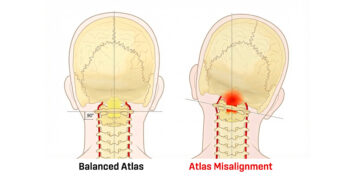 The Cranial-to-Distal Areas of Influence of Atlas Therapy