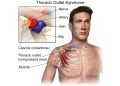 The Hidden Cause of Shoulder and Neck Pain: Thoracic Outlet Syndrome (TOS)