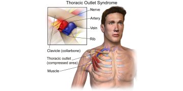 The Hidden Cause of Shoulder and Neck Pain: Thoracic Outlet Syndrome (TOS)