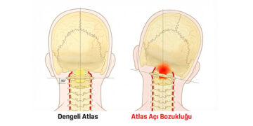 Atlas Terapi’nin Kraniyalden Distale Etki Alanları