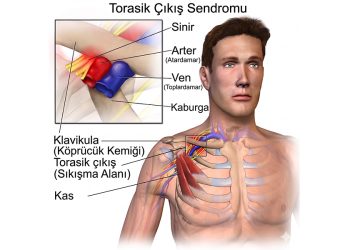 Omuz ve Boyun Ağrısının Gizli Sebebi: Torasik Outlet Sendromu (TOS)