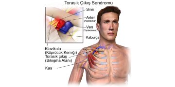 Omuz ve Boyun Ağrısının Gizli Sebebi: Torasik Outlet Sendromu (TOS)
